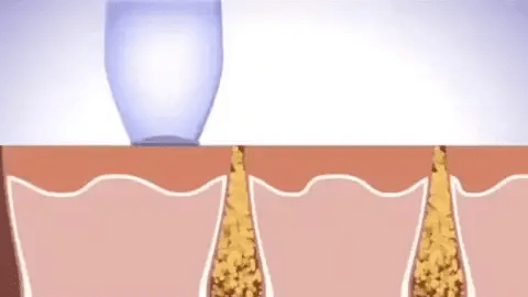 PoroClean™ Eliminador de puntos negros